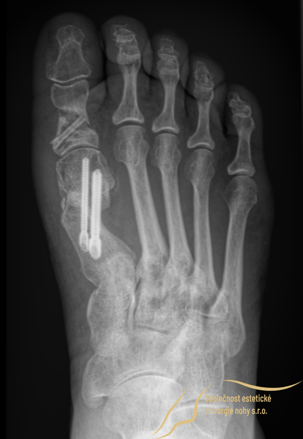 Pooperačná rengenová snímka pravej nohy